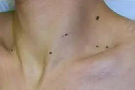 祛了600多颗痣！医生忠告：易癌变的有这5种表现，现在知道还不晚图片