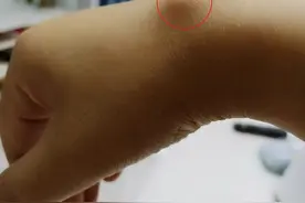 几个月时间，腕痛发展为腱鞘囊肿！医生提醒：这个病女同志易发图片