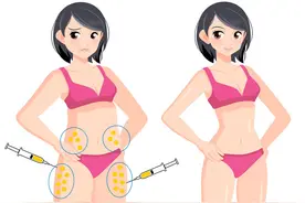 想靠抽脂“躺瘦”？专家提醒：整形有风险，爱美需谨慎图片