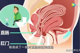 便秘、腹胀......“疝”小也有大麻烦，这类人群高发，易被误诊，别不当回事图片