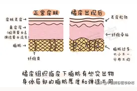 “橘皮组织”该怎么消除？图片