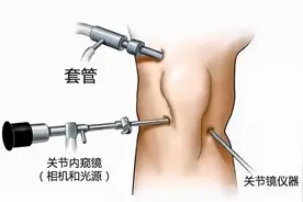 关节镜，究竟如何拯救您的关节图片