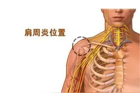 颈肩部疼痛，除了颈椎病肩周炎这一情况外，也有可能是肿瘤图片