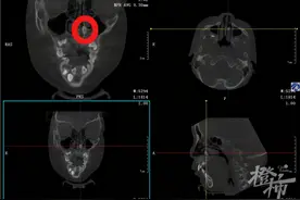 6岁女童鼻子里“长牙”！孩子牙齿出现这些症状，家长要当心图片