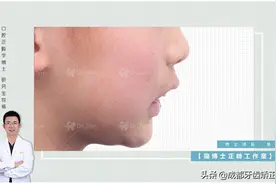 「简博士优质案例」——青少年触及下颌导下颌向前（二）图片