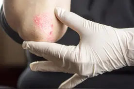 非特异性外阴炎之单纯性外阴炎，关爱女性健康从自己做起图片