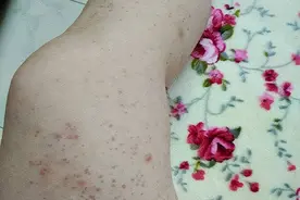 身上长了小红点，是肝病的表现吗？3个潜藏病因，了解一下图片