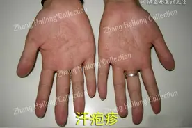 手上长了汗疱疹怎么办？图片