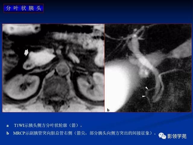 胰腺的解剖与常见变异