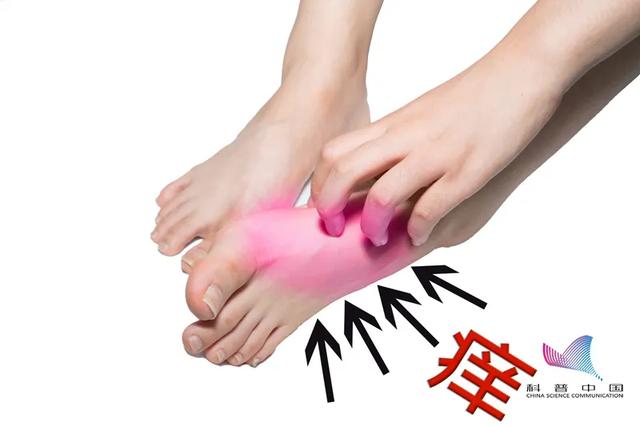 脚气中的角化皲裂型图 脚气中的角化皲裂型图