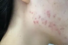怎样正确地用水杨酸去闭口？图片