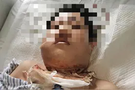 一颗智齿引发重症感染，男子抢救40天保住性命图片