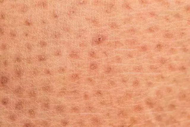 长毛周角化咋办