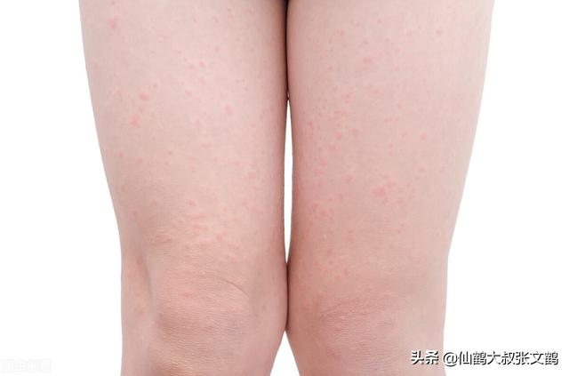 什么叫皮肤角化