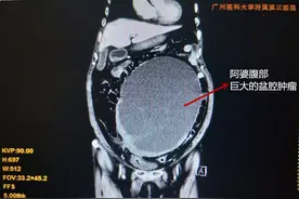 广州90岁阿婆腹大似孕7月，竟是巨大盆腔肿瘤作怪图片