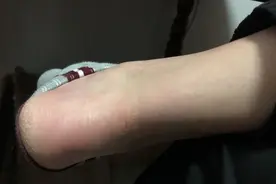 伤口吓人！小伙雨天踩了个水坑，腿烂一大片，一查竟染上了“丹毒”图片