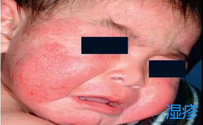 小孩胳膊膝盖鸡皮肤图片大全