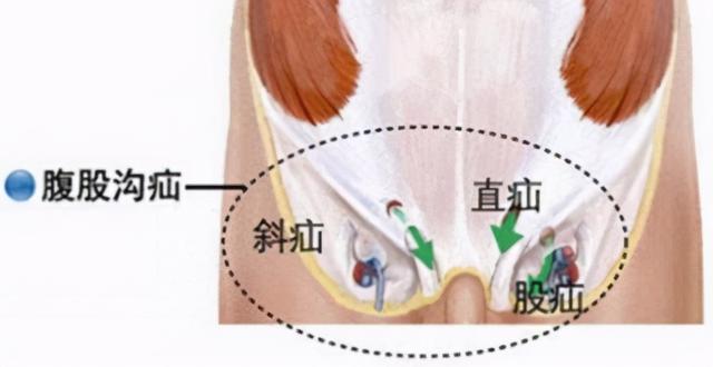 当心，有这些症状基本可以确诊为腹股沟疝了