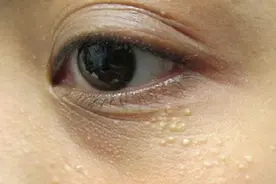 眼角的脂肪粒难消除？2个“必杀计”，不用针挑和手抠，轻松消除图片