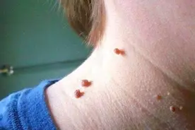 脖子上长的小肉粒是什么？可以直接揪掉吗？如何治疗？一文全说清图片