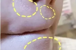 下巴一抿出来的小痘痘好难看，5招全部杀光光图片