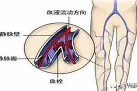 腿痛腿肿的元凶——下肢深静脉血栓图片