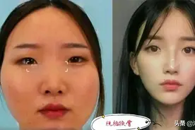 女子嫌自己丑花30万整容，前后对比惊人，宅男：纸片人才诚不欺我图片