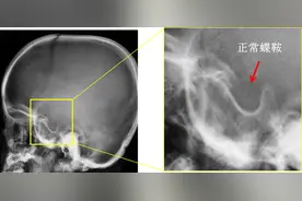 影像报告解读：空蝶鞍咋回事图片