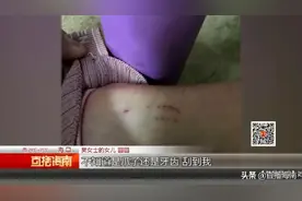女孩小区内被老鼠咬伤，业主质疑管理不到位，物业回应→图片