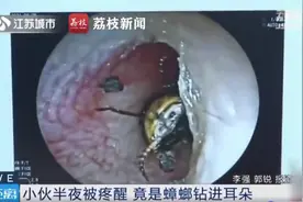 惊出冷汗！年轻小伙半夜被疼醒，医生竟从其耳朵中取出一大只蟑螂图片