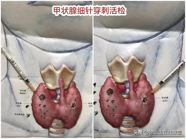 甲状腺结节有什么忌口 2026年甲状腺结节10大忌口＂,＂no_ai_sug＂:true},{＂