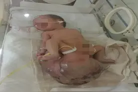 5个月胎儿在妈妈腹中被查出肿瘤，完整切瘤后，体重减轻三分之一图片