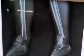 「病案实录」10岁男孩小腿骨折，微创手术助其康复图片