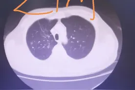 刘懿博士说肺癌（二六六七）肺磨玻璃结节消融术后变大，进展了？图片