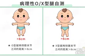 3岁娃腿部畸形，只因过早扶站、用学步车！5个习惯最毁腿型图片