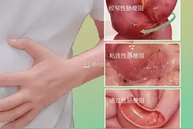 吃个糯米饭，肠子堵住了！干饭不当，小心没命！图片