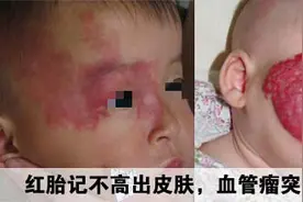 什么是鲜红斑痣？该如何辨别？图片