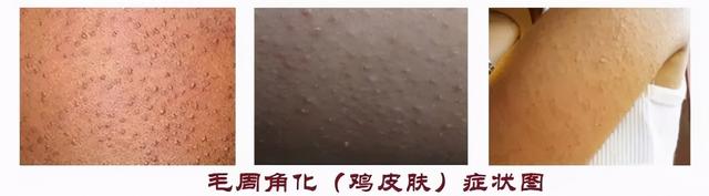 脸上有些皮肤像鸡皮