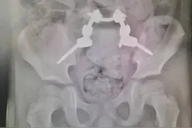 警惕！踩到阳台晾衣水迹，青岛12岁女孩从四楼坠落，全身多处骨折危及生命图片