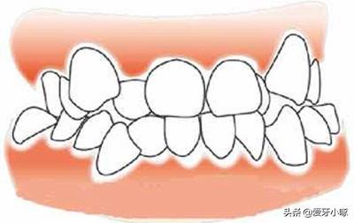 口腔角化龈的概念