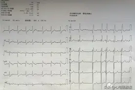 心房颤动？完全性右束支阻滞？心肌病？图片