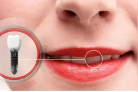 做种植牙对日后检查身体拍片、拍磁共振是否有影响？图片