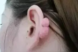 福建一女子耳后长出“肉蘑菇”，竟是10多年前打耳洞惹的祸！这类体质的人要小心图片