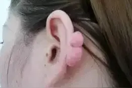 福建一女子耳后长出“肉蘑菇”，竟是10多年前打耳洞惹的祸！这类体质的人要小心图片