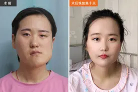 歪脸女孩在沈阳成功完成第二阶段手术，容貌让人惊艳……图片