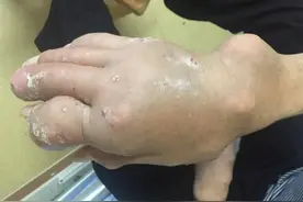 吓人！小伙手脚密密麻麻长满“石头”，不幸截瘫！医生叹息：这习惯很多人都有图片