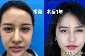 外切缩鼻翼会留疤吗？鼻翼整形都包括哪些项目图片