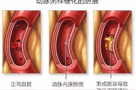 戒烟半年，突发心梗，45岁后戒烟到底好不好？突然戒烟伤害更大？图片