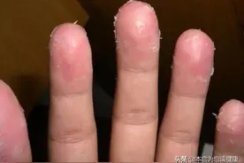 孩子的手老是脱皮，妈妈千万别大意，医生：可能和这3种病有关系图片
