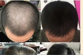 脱发统一用康王？不分清脱发类型，什么生发剂都没用图片